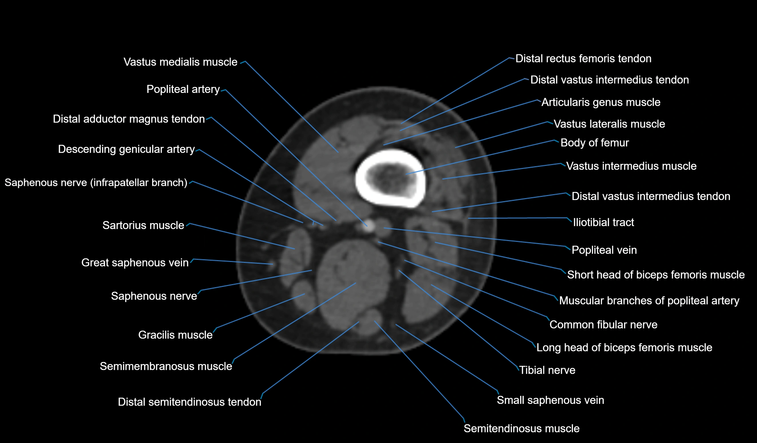 CT knee axial cross sectional anatomy labelled image-00004.webp